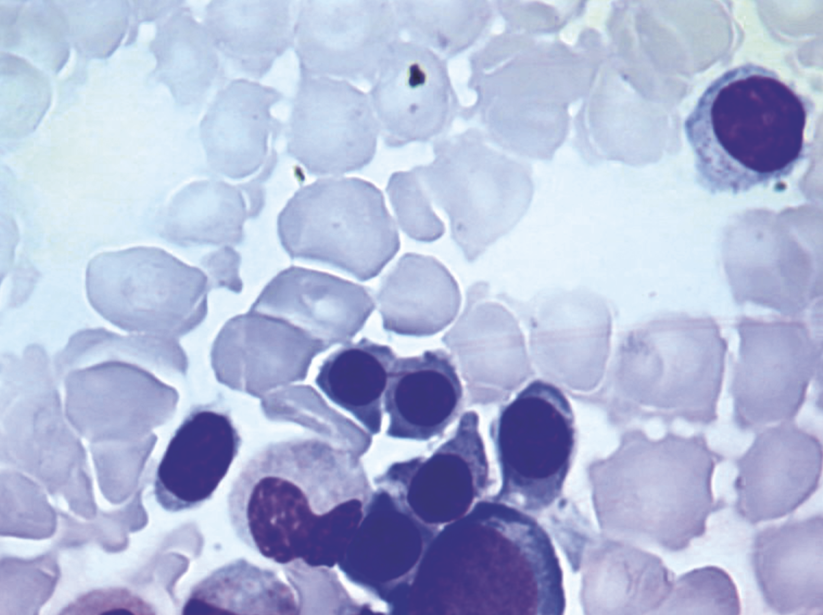Pathologies du Globule Rouge et du Fer - Horizons Hémato